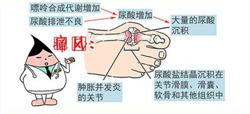 盘锦痛风治疗新进展：健康生活与科学疗法齐头并进