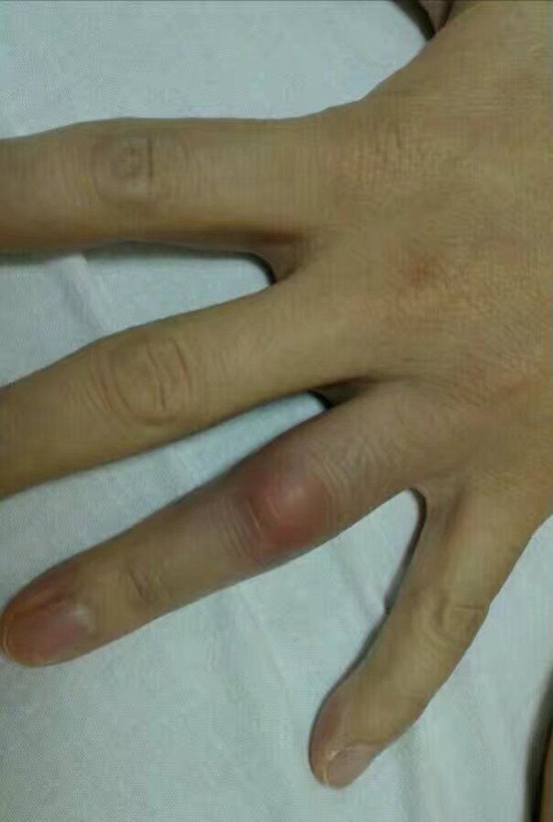 痛风在辽宁盘锦的现状与防治